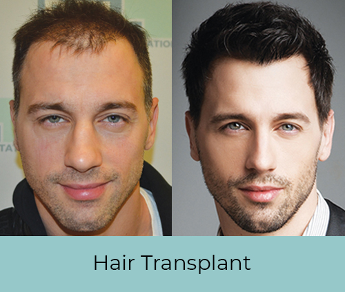 New Roots Hair Transplant on Twitter Grade 7 Baldness Hair Transplant  Planning  Best Hair Transplant Clinic In Kolkata   For More  Info  Call  WhatsApp  India 919325558888 Bangladesh 