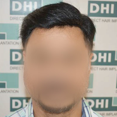 Hair Transplant in Bangalore - DHI International