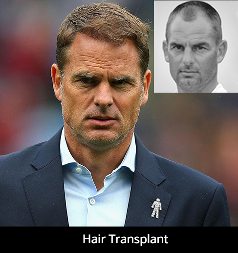 hair-transplant