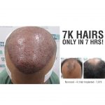 Hair Transplant of 7,000 Hairs in 7 hours only!