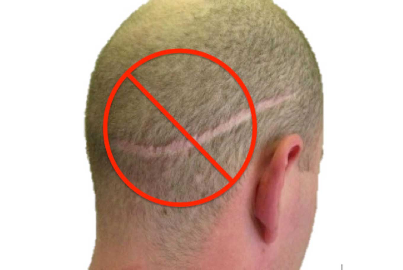 Hair Transplant: Hair Transplant Cost & Procedure from DHI International Hair Transplant: Hair Transplant Cost & Procedure from DHI International