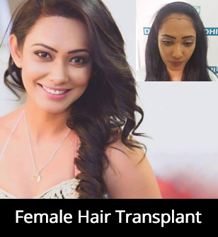 DHI- Most Advanced Hair Transplant Technique in Hair Transplant Industry