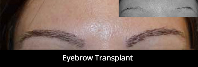 eyebrow-hair-transplant