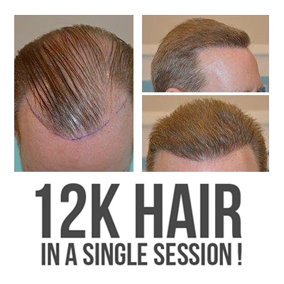12,000 plus follicles implanted for a complete transformation, in just 11  hours! - DHI International