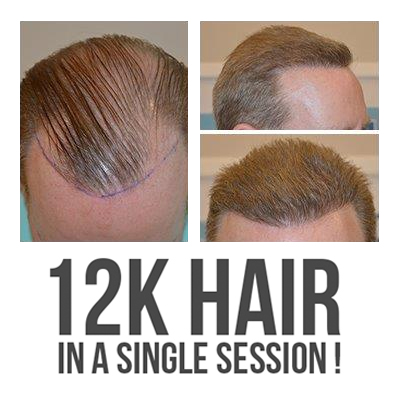 Best Hair Transplant in Bangalore 2023  Looks Studio  Hair Transplant   Looksstudio  Blog