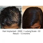 Natural, fair density result from a female hair transplant case