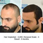 Hair Transplant Results of a Celebrity Hair Stylist - DHI International