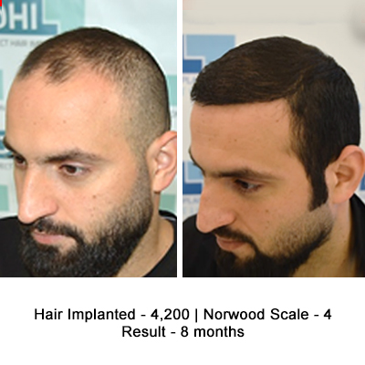 Hair Transplant Results of a Celebrity Hair Stylist - DHI International