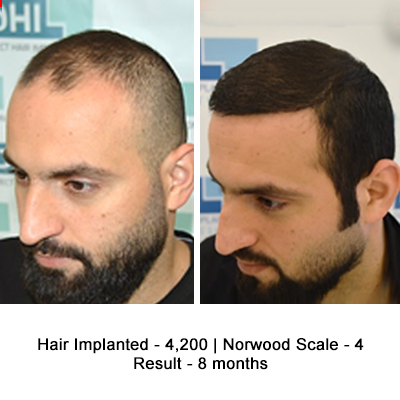 Hair Transplant Results of a Celebrity Hair Stylist - DHI International Hair Transplant Results of a Celebrity Hair Stylist - DHI International