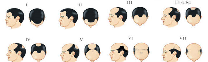 Hair Loss Scale Beverly Hills | Genetic Pattern Loss Los Angeles