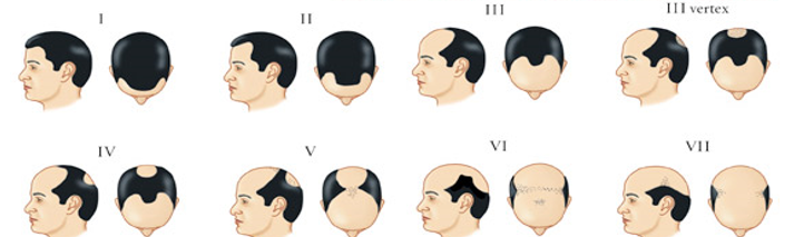 Ludwig scale  Types of hair loss – Neofollics