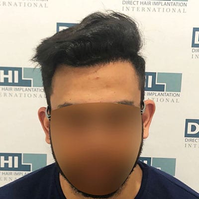 hair-transplant-dhi