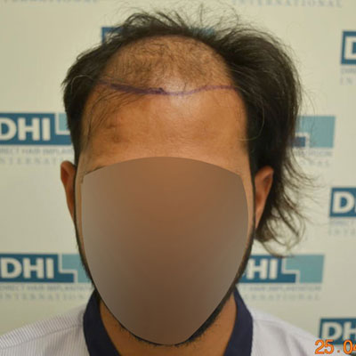 before-after-dhi-7