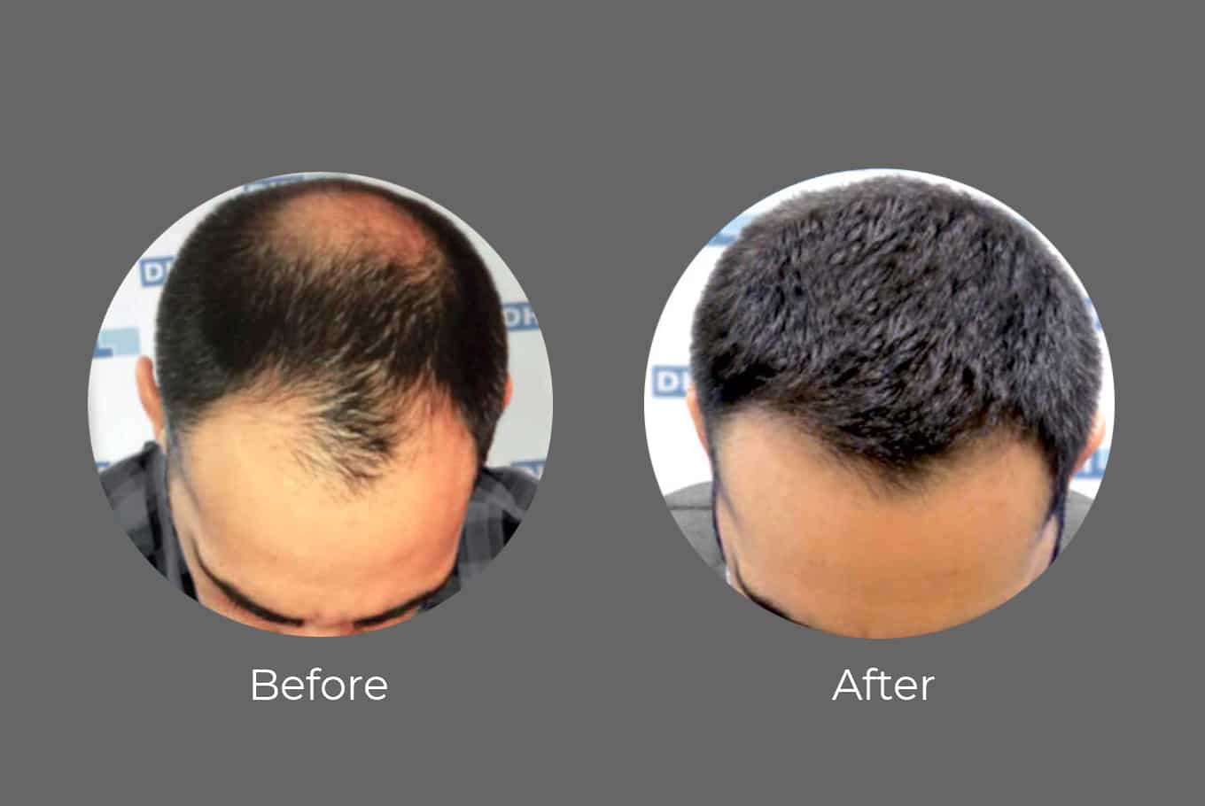 Hair transplant in India