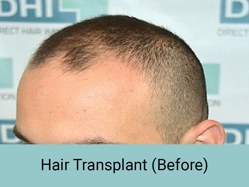 Hair Transplant in Delhi | Best Hair Transplant Clinics - DHI International Hair Transplant in Delhi | Best Hair Transplant Clinics - DHI International