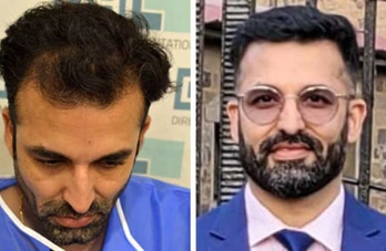 before-after-hair-transplant