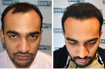 before-after-hair-transplant