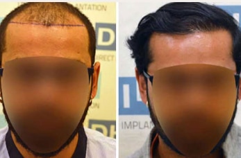 before-after-hair-transplant