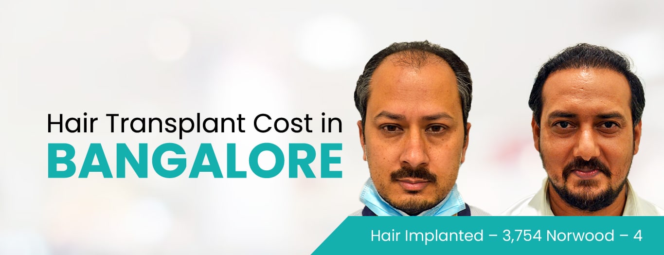 Hair Transplant Cost in Bangalore India