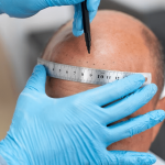 1000-grafts-hair-transplant-cost