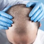 10000 Grafts Hair Transplant Cost in India