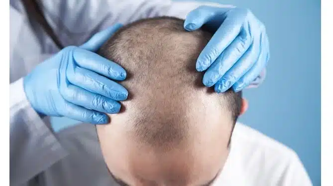 Chi phí cấy tóc 10000 tại Ấn Độ