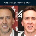 nicolas-cage-hanks-hair-transplant