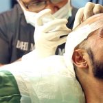 Cost of hair transplant procedure