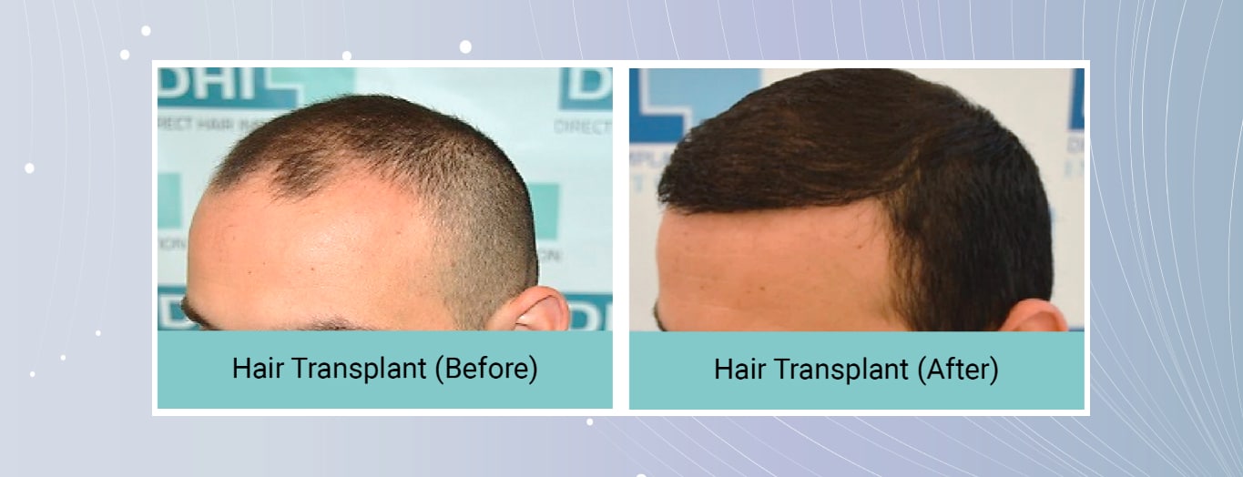 hair-transplant-cost