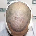 Best Hair Transplant Clinic in Delhi