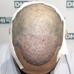 Post hair transplant surgery