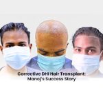 Mr. Manoj Kumaran Hair Transplant Journey