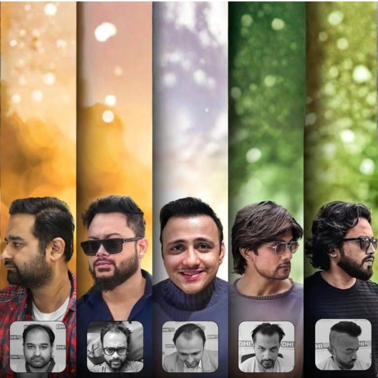 Hair Transplant Results That Speak for Themselves: How DHI Sets a Global Benchmark