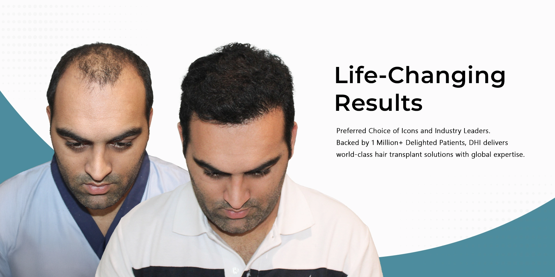 Hair Transplant Result