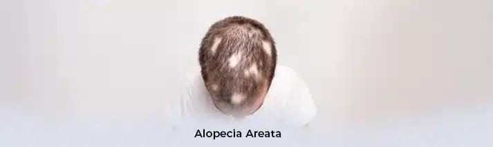 Alopecia Areata