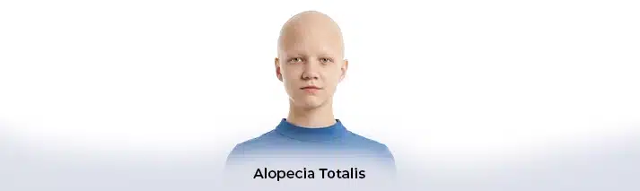 Alopecia Totalis