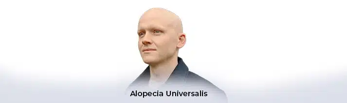 Alopecia Universalis