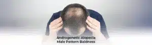 Male Pattern Baldness