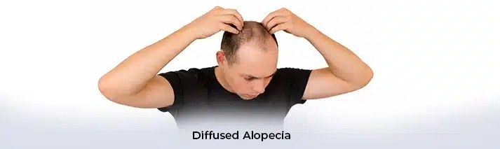 Diffused Alopecia
