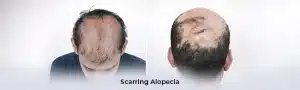 scarring Alopecia