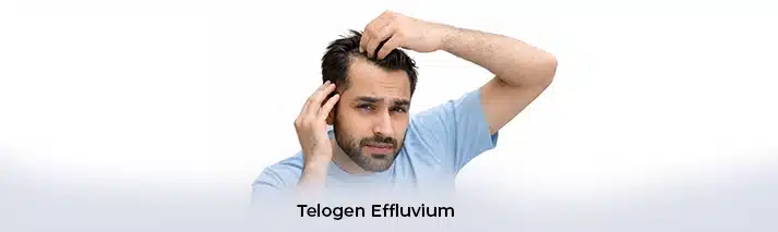 Telogen Effluvium