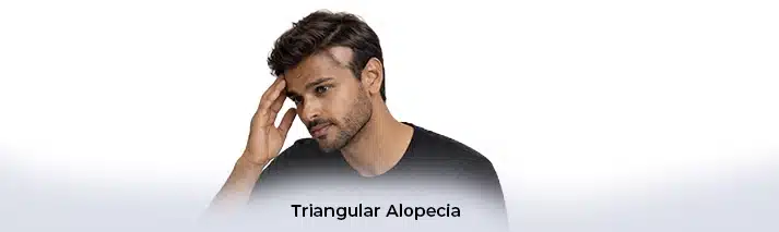 T riangular Alopecia